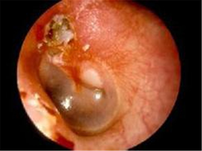 嚴重的急性中耳炎