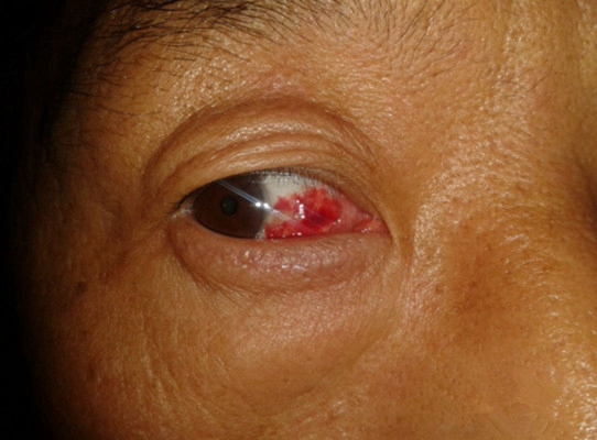 眼睛裡有血塊