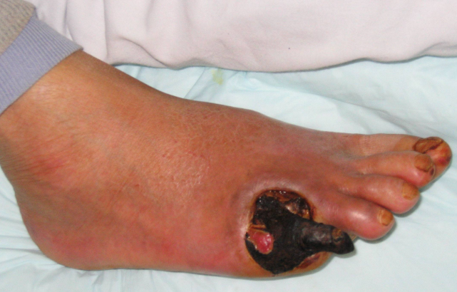 脈管炎早期症狀