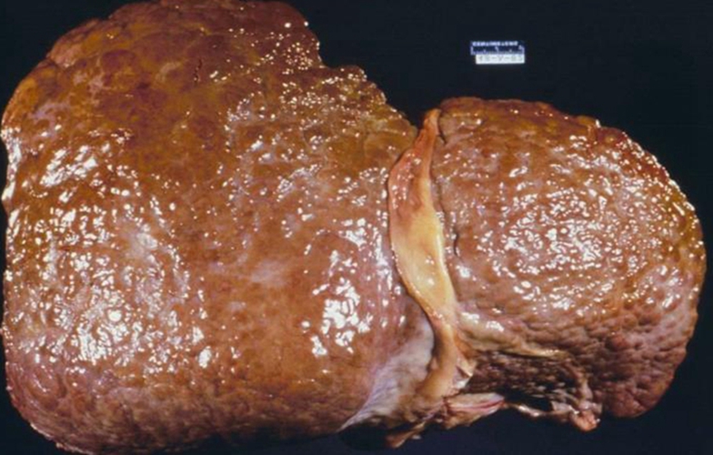  重度的酒精肝的併發症