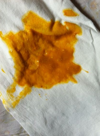 新生兒消化不良大便圖 (51) 