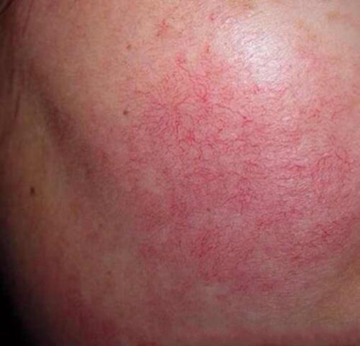 過敏性接觸性皮炎