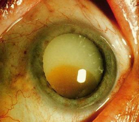 白內障的早期症狀