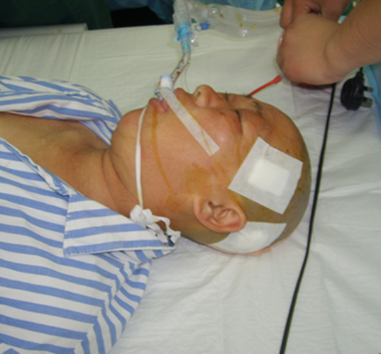 男性喉腫瘤術後的