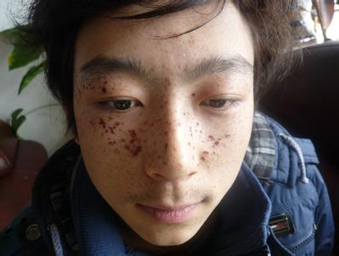 年輕人臉上長老年斑