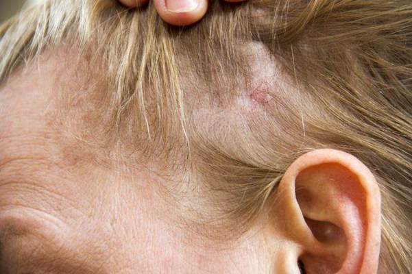 頭皮脂溢性皮炎 (49) 