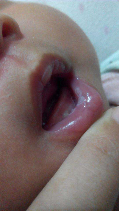 寶寶鵝口瘡 (62) 
