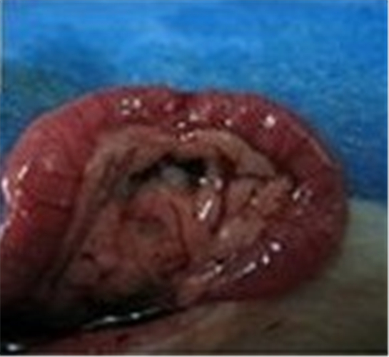 重症急性胰腺炎胰腺