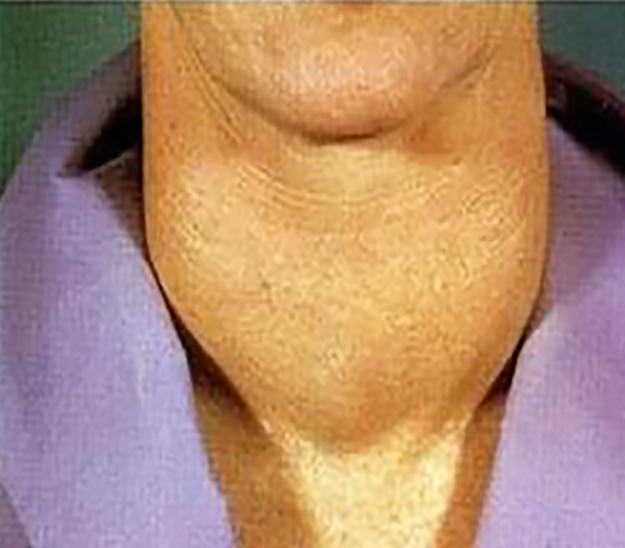 雙側甲狀腺腫大症狀