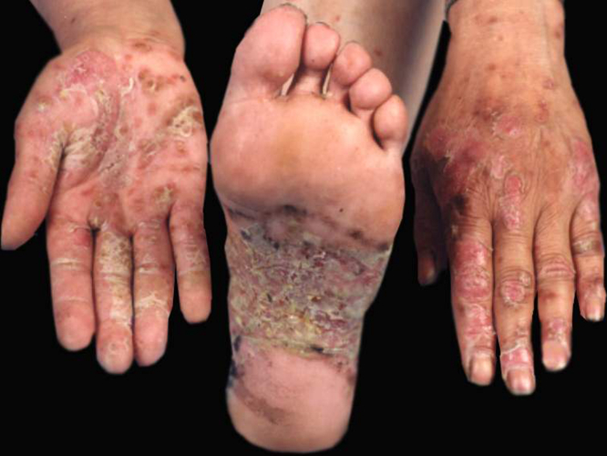 手掌足蹠大皰性皮膚病