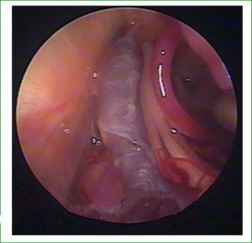 微創治療三叉神經痛的
