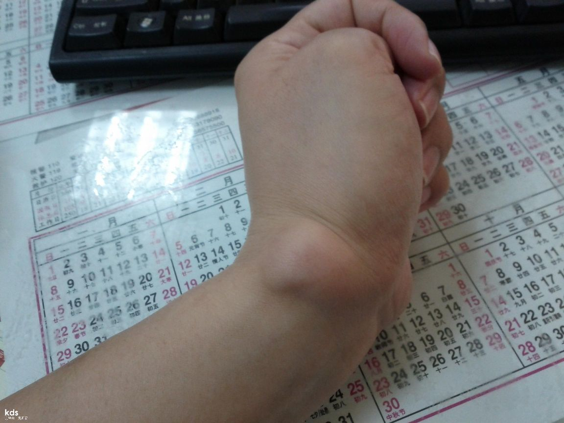 左手手腕腱鞘炎高清