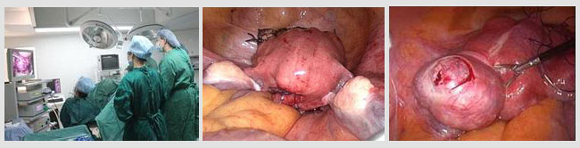 子宮肌瘤手術過程