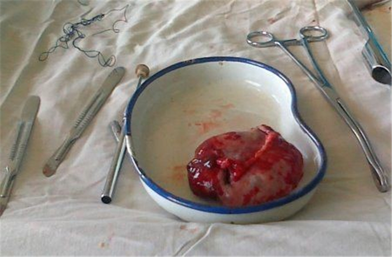 切除卵巢癌惡性畸胎瘤