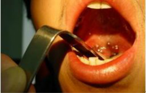 扁桃體癌圖  (66) 