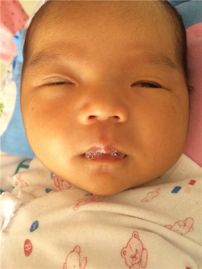 新生兒肺炎吐泡泡 (9) 