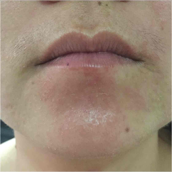 真實症狀臉部流感