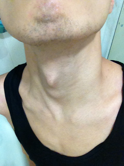 頜下淋巴結腫大