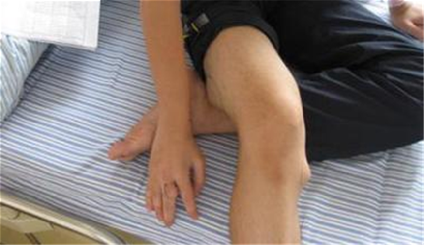 腿骨良性骨腫瘤