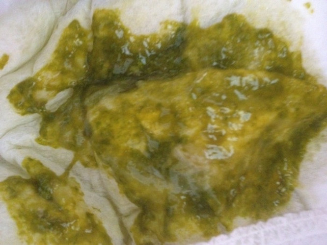 一個月嬰兒母乳性腹瀉大便