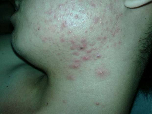 血熱的症狀痘痘