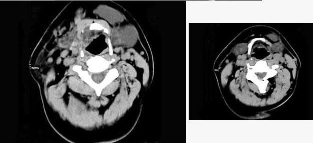 扁桃體癌圖  (65) 