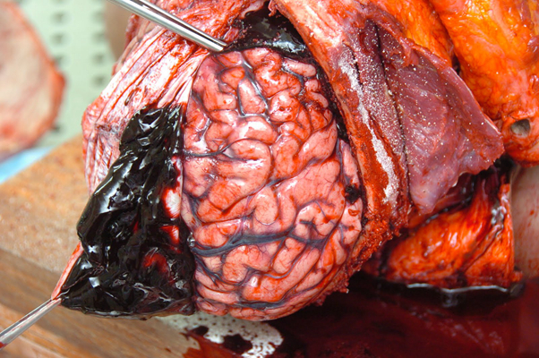 硬膜下血腫 (45) 