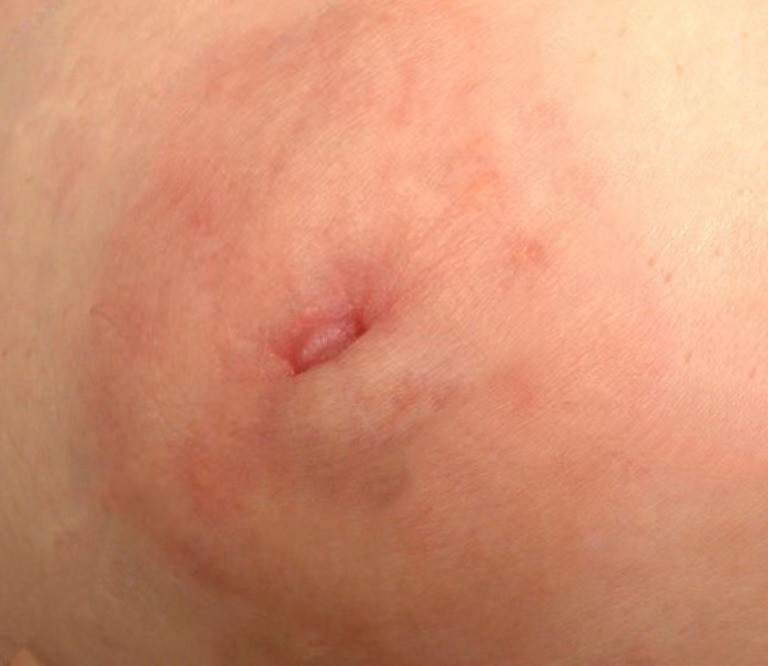 小女孩乳頭內陷