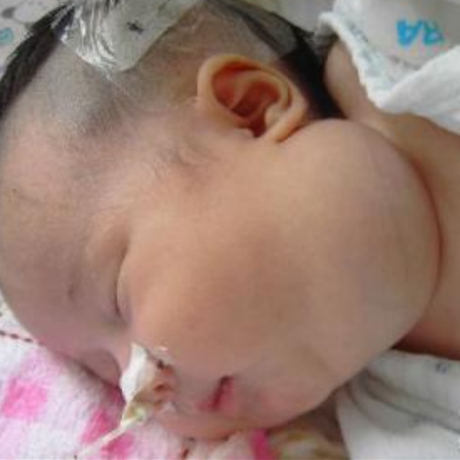 幼兒淋巴癌早期症狀