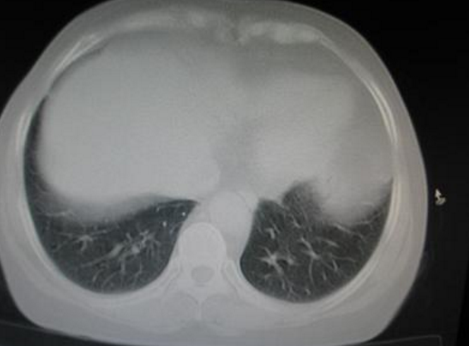 肋間神經炎疼痛部位