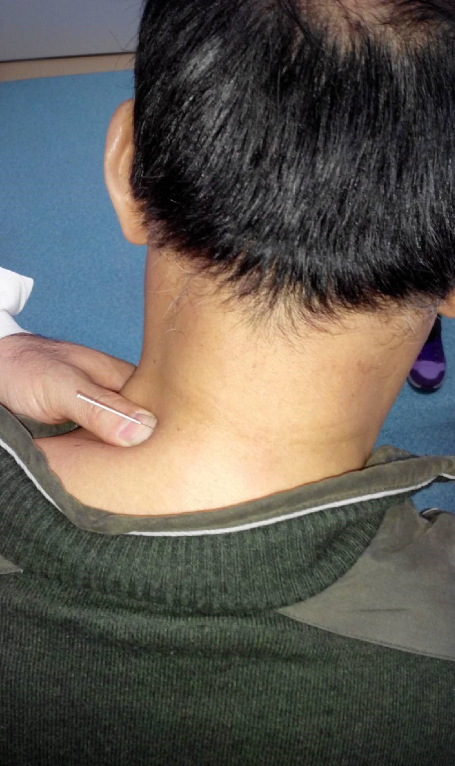 針灸治療痙攣性斜頸的