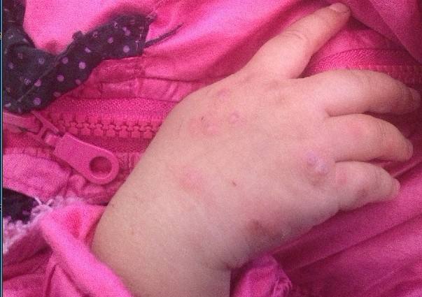 結節性癢疹 (48) 