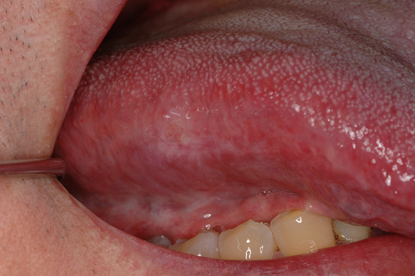 舌癌的初早期症狀