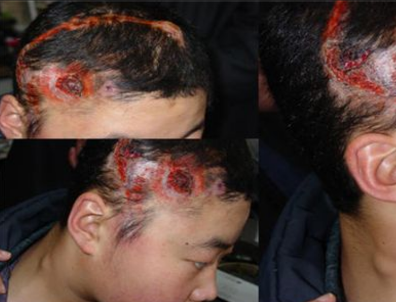 霍奇金淋巴瘤症狀 