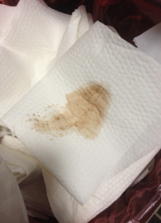 白帶帶有褐色分泌物 (63) 