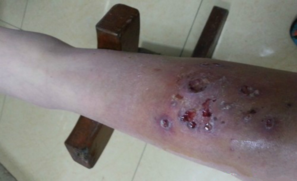 小腿皮膚念珠菌病