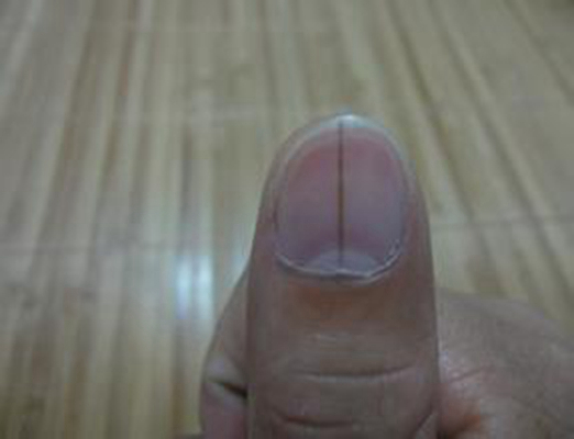 手指甲上有豎紋圖解 (41) 