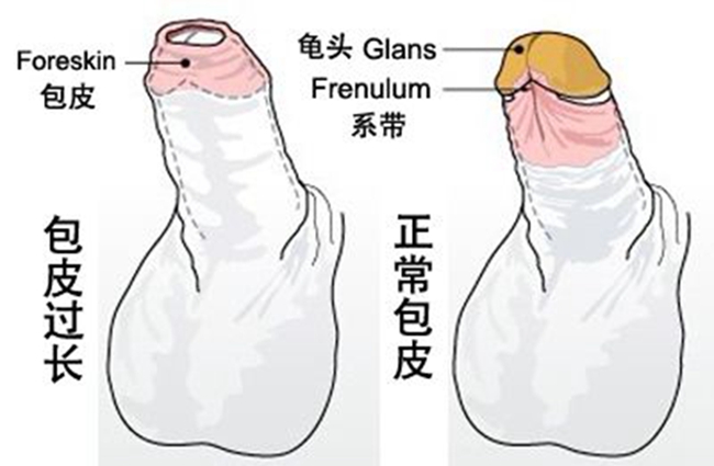 嵌頓包莖鬆解術 