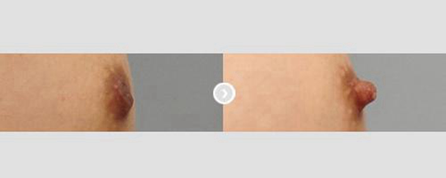 新生兒乳頭內陷的