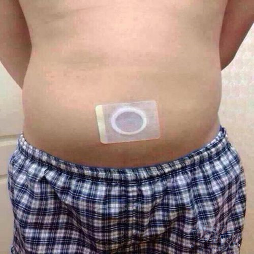 臍療治療細菌性痢疾的