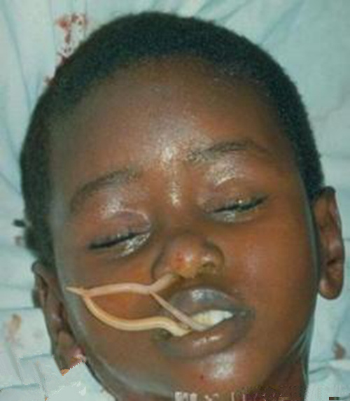 蛔蟲病症狀臉部