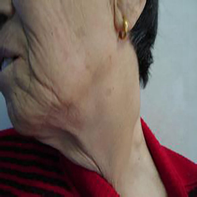 頜下淋巴結腫大