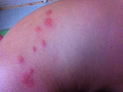 被跳蚤咬的症狀