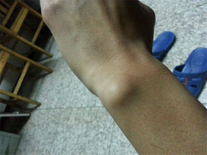 右手手腕腱鞘炎