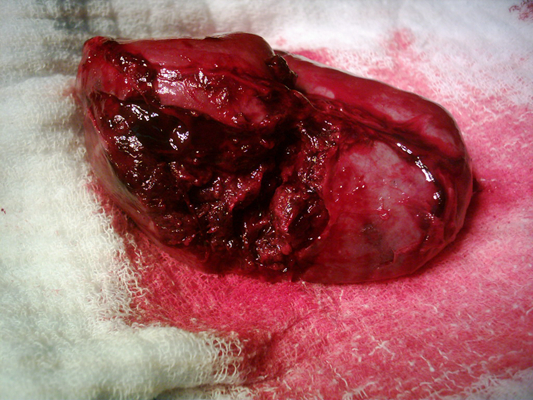 硬膜下血腫 (48) 