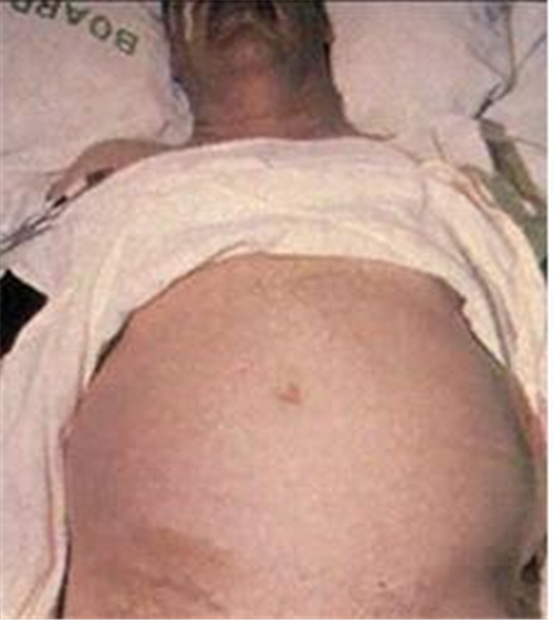 男性急性胰腺炎