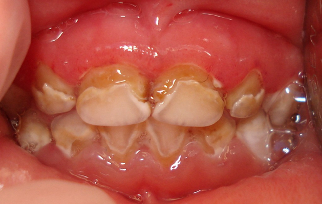 牙齦炎和牙周炎