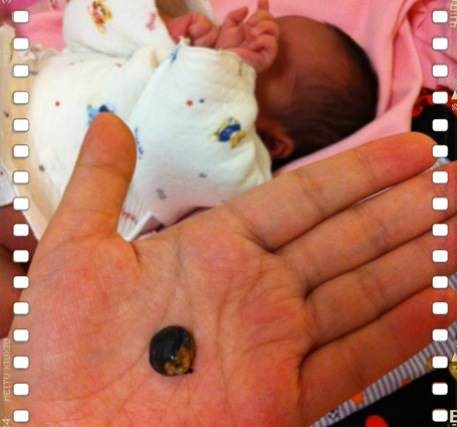 新生兒肚臍脫落圖 (43) 
