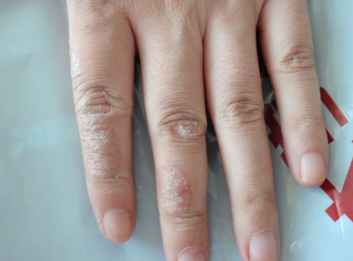 水皰型手癬