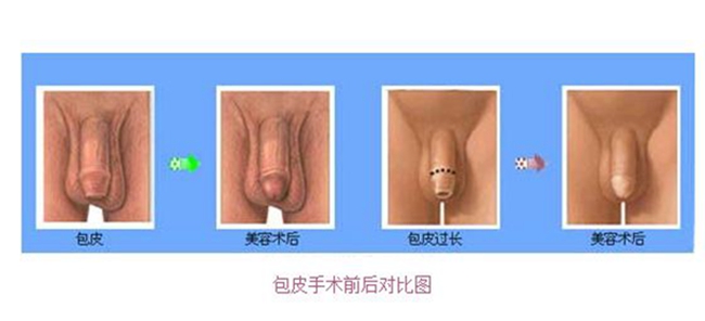 用手復位 嵌頓包莖 